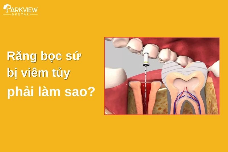 Răng bọc sứ bị viêm tủy phải làm sao? Có nguy hiểm không?