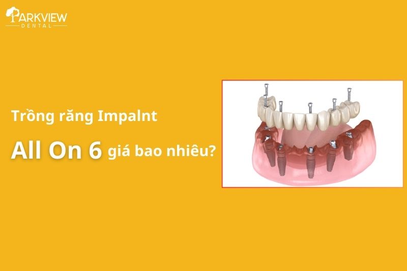 trồng răng implant all on 6 giá bao nhiêu