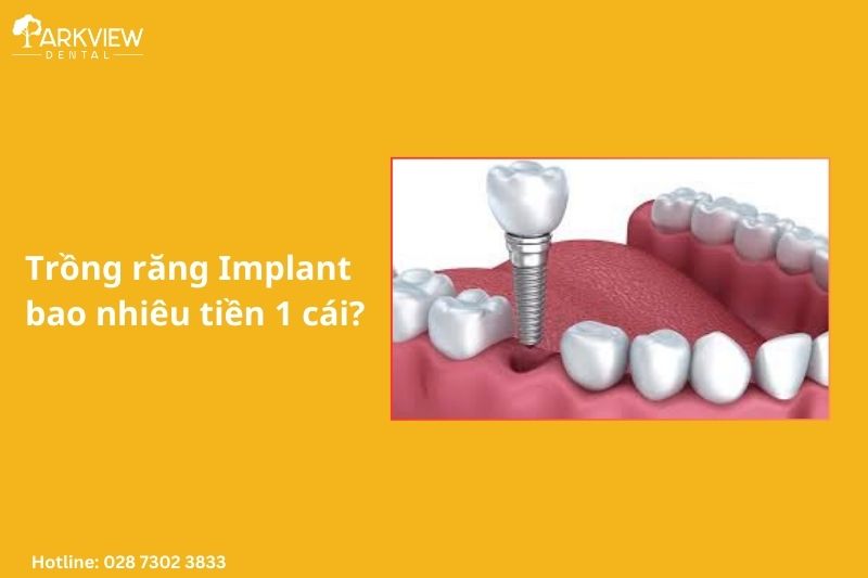 trồng răng implant bao nhiêu 1 cái