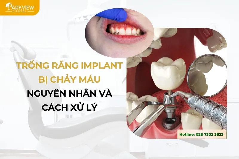 trồng răng implant bị chảy máu