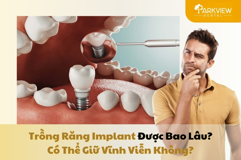 trồng răng implant được bao lâu