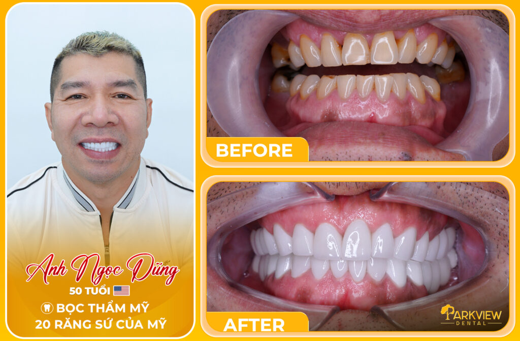  Hành Trình Tái Tạo Nụ Cười Với 20 Răng Sứ Thẩm Mỹ