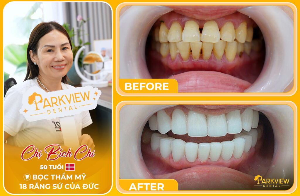 Hành trình bọc 18 răng sứ Đức kết hợp cấy Implant tại Parkview Dental
