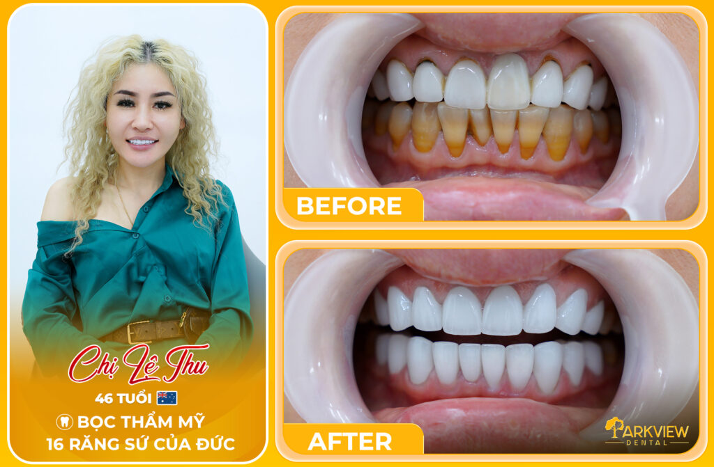 Khắc phục bọc sứ hỏng hành trình tìm lại nụ cười của chị Lệ Thu tại Parkview Dental