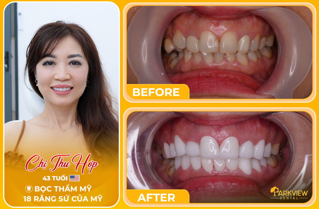 Phục hình nụ cười mới với 18 răng sứ thẩm mỹ sau 10 năm