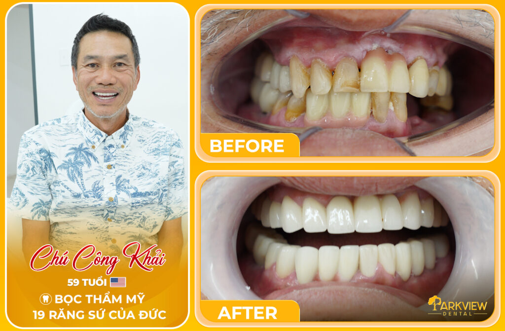 Hành trình cải thiện nụ cười và chất lượng sống của chú Công Khải tại Parkview Dental