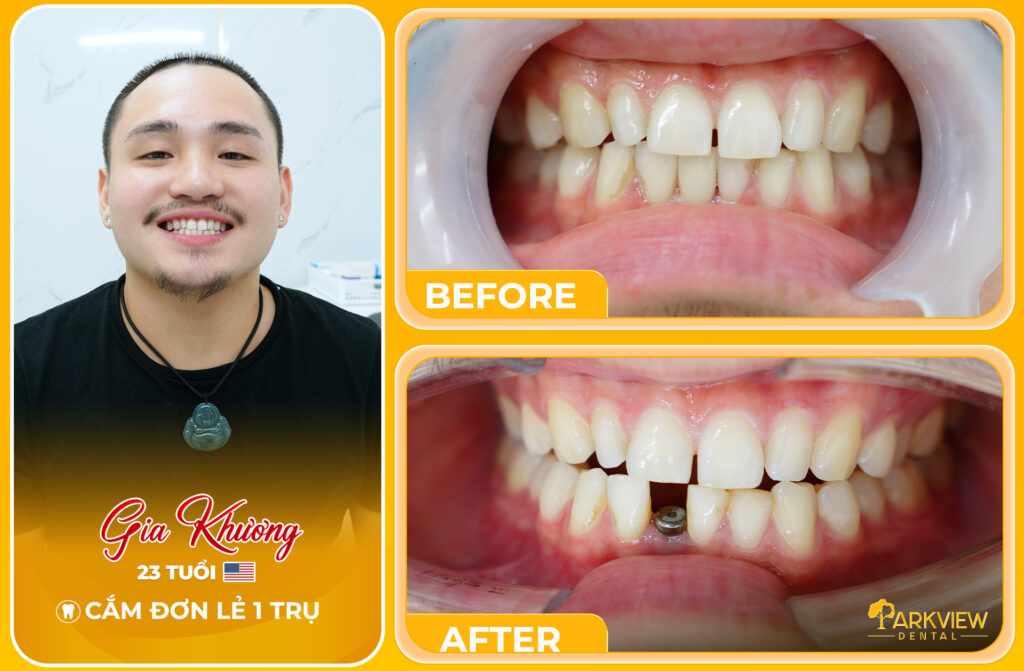 Trồng 1 Trụ Implant Cho Người Trẻ Giải Pháp Phục Hình Nhanh Gọn Và Không Đau