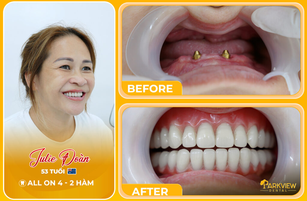 Phục Hồi Răng Toàn Diện Bằng Cấy Implant Zygoma Và All On 4 Cho Người Mất Răng Lâu Năm